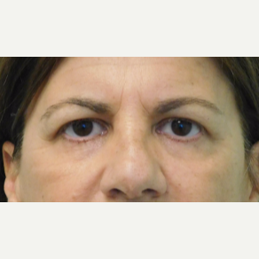 45-54 year old woman treated with Brow Lift and Upper Eyelid Lift before 3749128