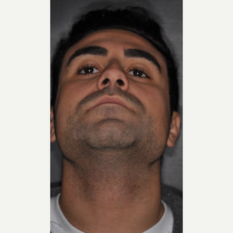 18-24 year old man treated with Septoplasty 6 weeks post-op before 3500192