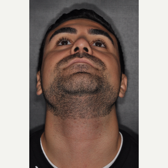 18-24 year old man treated with Septoplasty 6 weeks post-op after 3500192