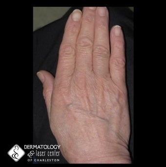 Aging Hands before 340590