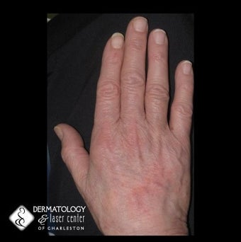 Aging Hands after 340590