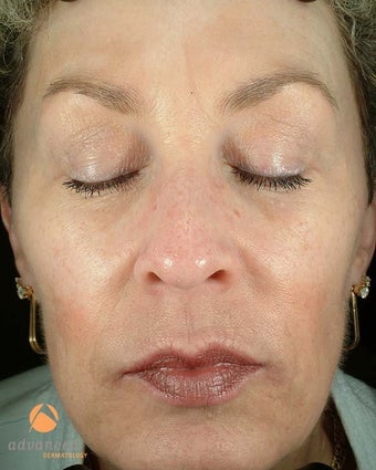 Female Treated with BOTOX® Cosmetic and Restylane® after 1047006
