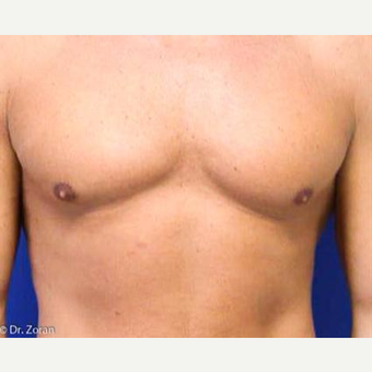35-44 year old woman treated with Liposuction before 3066184