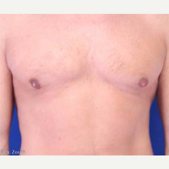 35-44 year old woman treated with Liposuction after 3066184