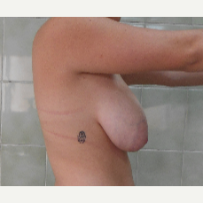 18-24 year old woman treated with Breast Lift with Implants before 3410984