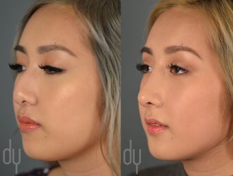 Asian Rhinoplasty with rib cartilage and DCF before 2465773
