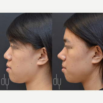 18-24 year old woman treated with Asian Rhinoplasty before 3622589