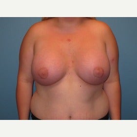 25-34 year old woman treated with MTF Breast Augmentation after 2486799