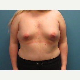 25-34 year old woman treated with MTF Breast Augmentation before 2486799
