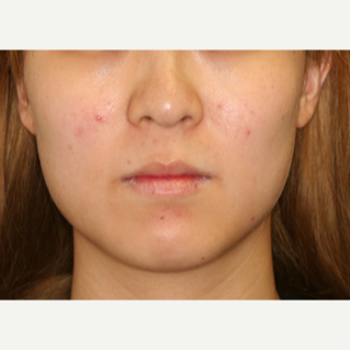 25-34 year old woman treated with Botox to the masseters to thin the face before 2706370