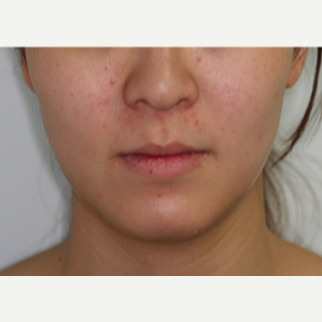 25-34 year old woman treated with Botox to the masseters to thin the face after 2706370