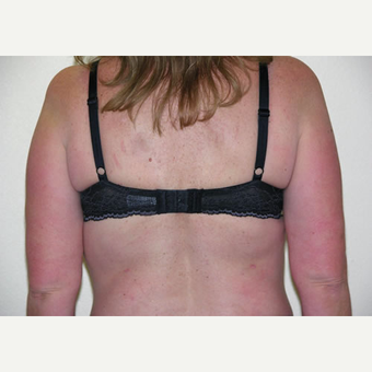 46 year old woman treated with Liposuction after 3693754