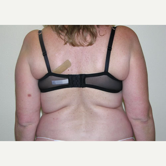 46 year old woman treated with Liposuction before 3693754