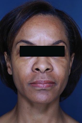 Fillers and Botox after 450549