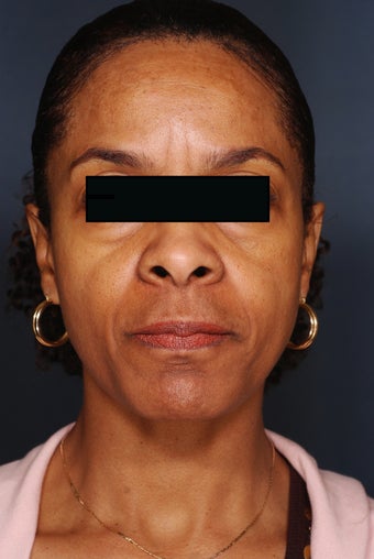 Fillers and Botox before 450549