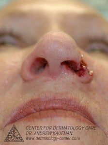 Mohs Surgery of Basal Cell Carcinoma and Recontruction 315015