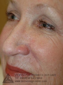 Mohs Surgery of Basal Cell Carcinoma and Recontruction after 315015