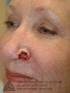 Mohs Surgery of Basal Cell Carcinoma and Recontruction before 315015
