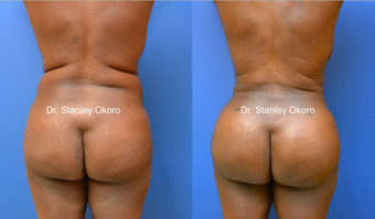 35 year old fat transfer to buttocks before 907516
