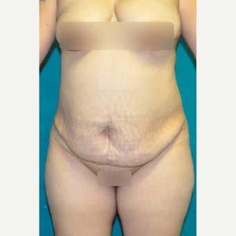 25-34 year old woman treated with Tummy Tuck before 1773403