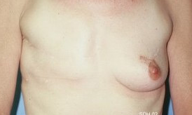 45-54 year old woman treated with Breast Reconstruction before 1675801