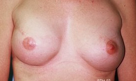 45-54 year old woman treated with Breast Reconstruction after 1675801