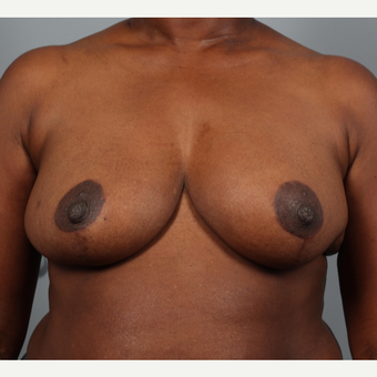 45-54 year old woman treated with Breast Reduction with Left Breast Reconstruction after 3423237