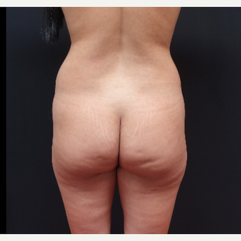 25-34 year old woman treated with Tumescent Liposuction before 3267175
