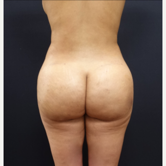 25-34 year old woman treated with Tumescent Liposuction after 3267175