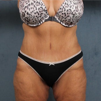 45-54 year old woman treated with Tummy Tuck after massive weight loss after 2108953