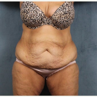 45-54 year old woman treated with Tummy Tuck after massive weight loss before 2108953