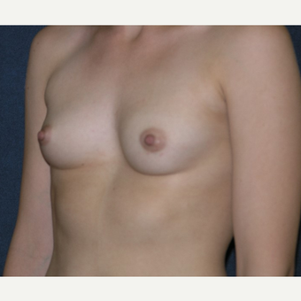 18-24 year old woman treated with Breast Implants before 3455656