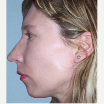 35-44 year old woman treated with Chin Implant before 3719142