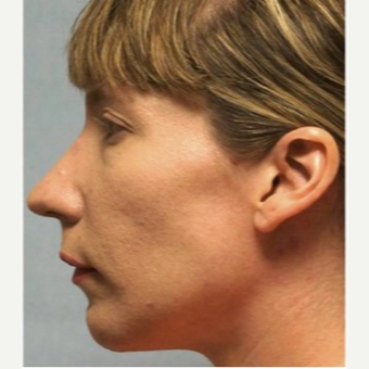 35-44 year old woman treated with Chin Implant after 3719142