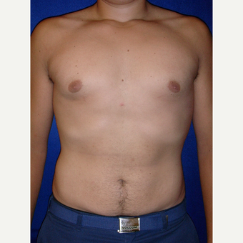 25-34 year old man treated with Male Breast Reduction after 3727301