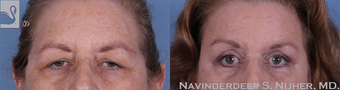 65-74 year old woman treated with Eyelid Surgery before 3768259