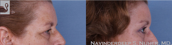 65-74 year old woman treated with Eyelid Surgery after 3768259