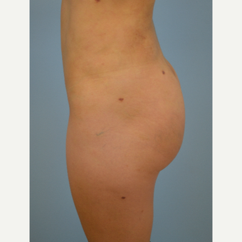 24 year old woman treated with Brazilian Butt Lift after 3432348