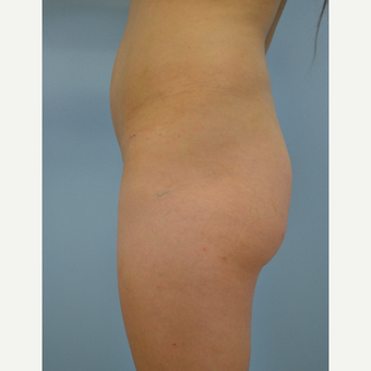 24 year old woman treated with Brazilian Butt Lift before 3432348