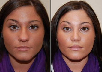 Rhinoplasty and Lip Augmentation with Silikon-1000 before 93774