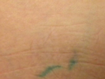 Tattoo Removal after 167234