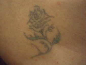 Tattoo Removal before 167234