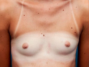 18-24 year old woman treated with Breast Augmentation before 3417984