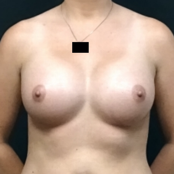 25-34 year old woman treated with Breast Augmentation after 3128393
