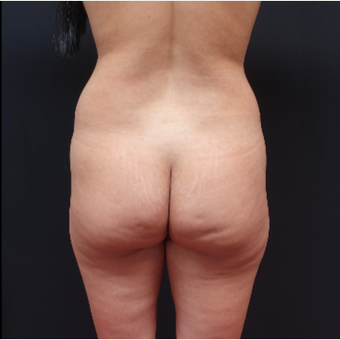 25-34 year old woman treated with Liposculpture before 3267093