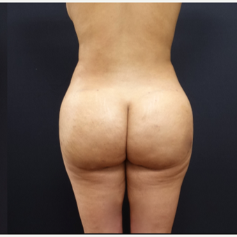 25-34 year old woman treated with Liposculpture after 3267093