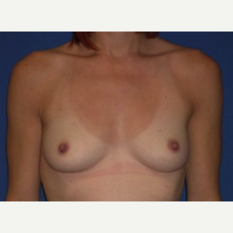 25-34 year old woman treated with Breast Implant Removal before 3219959