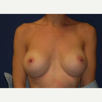 25-34 year old woman treated with Breast Implant Removal after 3219959