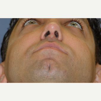 25-34 year old man treated with Revision Rhinoplasty after 3570387