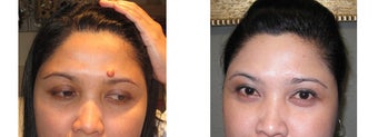Mole Removal photos before 951887